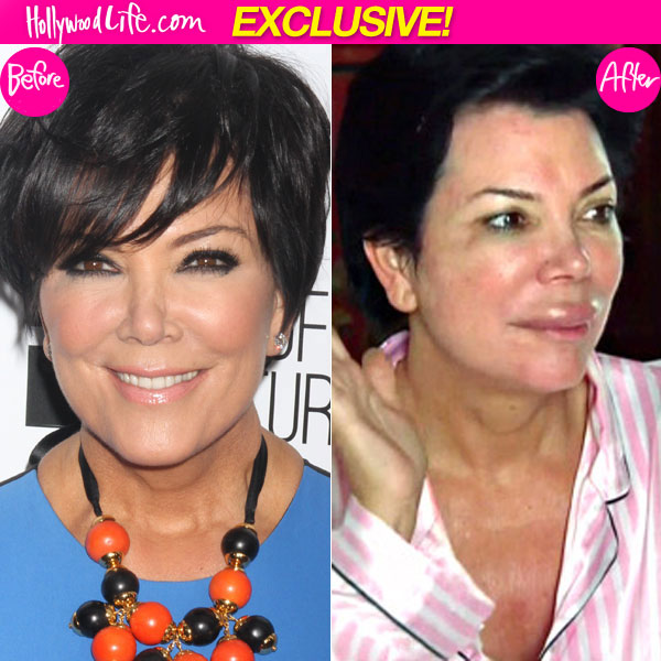 Kris Jenner Plastic Surgery Lips