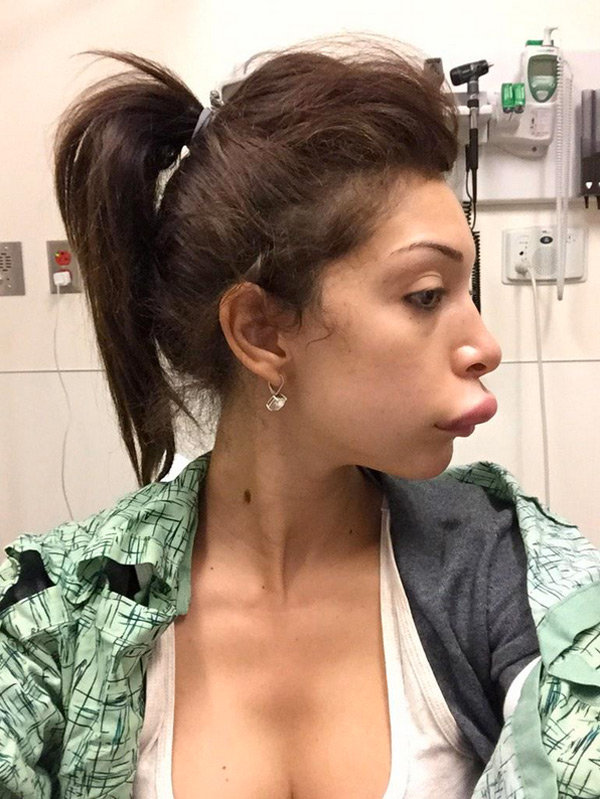 farrah-abraham-duck-lips-surgery-1