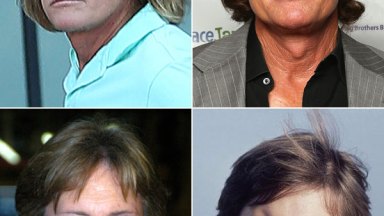 Bruce Jenner Plastic Surgery