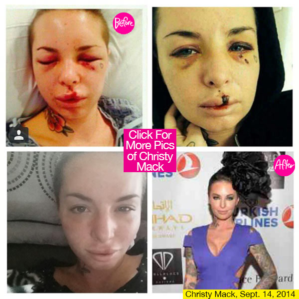 Christy Mack Recovery