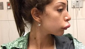 Farrah Abraham Botched Surgery