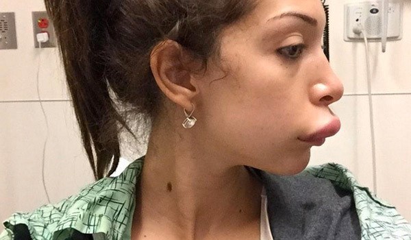 Farrah Abraham Botched Surgery