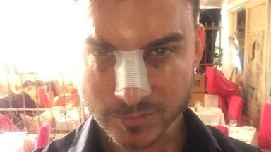 jax taylor nose job