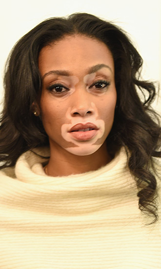 Winnie Harlow Celebrity Profile