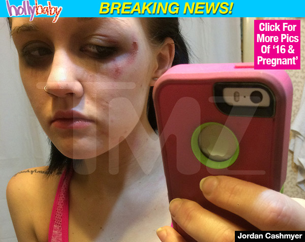 Jordan Cashmyer Rehab