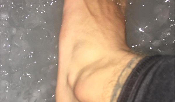 Justin Bieber Sprained Ankle