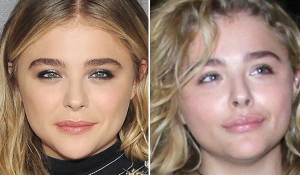 Chloe Moretz Lip Injections