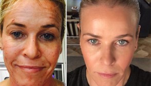Chelsea Handler Anti Aging Treatment