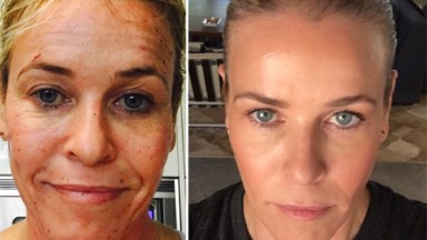 Chelsea Handler Anti Aging Treatment