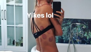 Hailey Baldwin Cupping