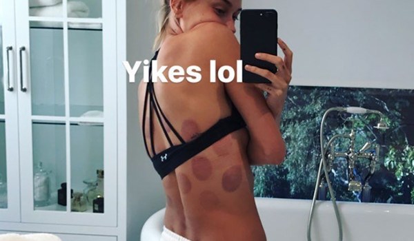 Hailey Baldwin Cupping