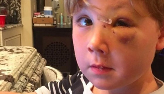 Kim Zolciak's son's dog bite